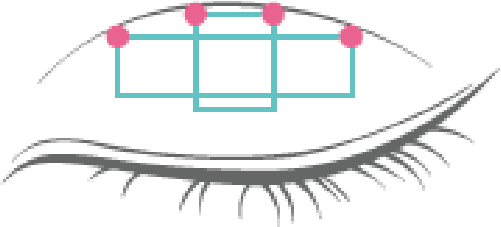 4点固定のシェーマ